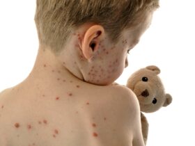 Representation for rashes caused because of Measles | Credits: Google images