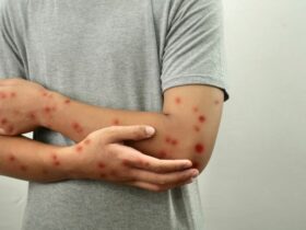 Measles Outbreaks Spread Globally