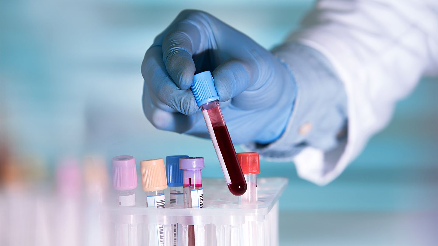 Liquid Biopsy Tests display high potential in early-stage Pancreatic Cancer